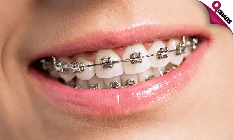 Metal Braces, Adjustment, Retainer & Consultation!